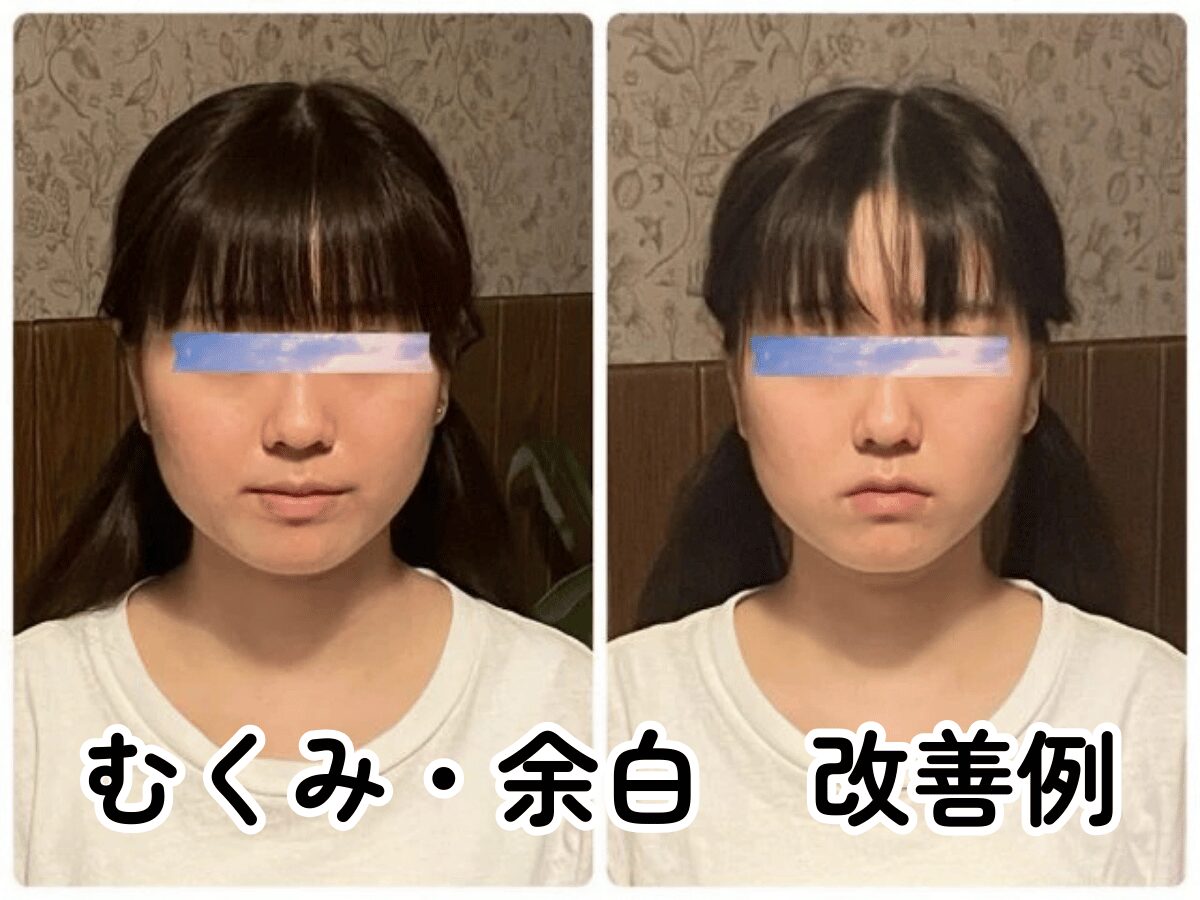 小顔矯正 むくみ 解消 ビフォーアフター 北九州小倉