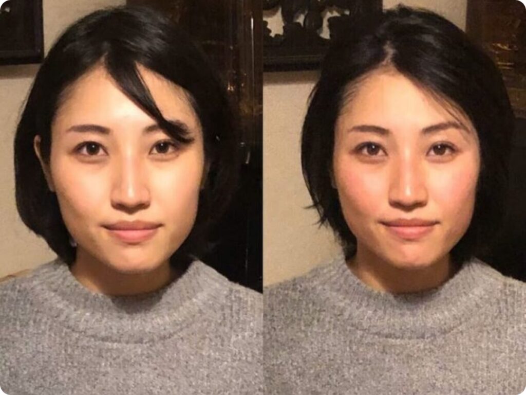 ブライダル 小顔矯正 ビフォーアフター 北九州小倉