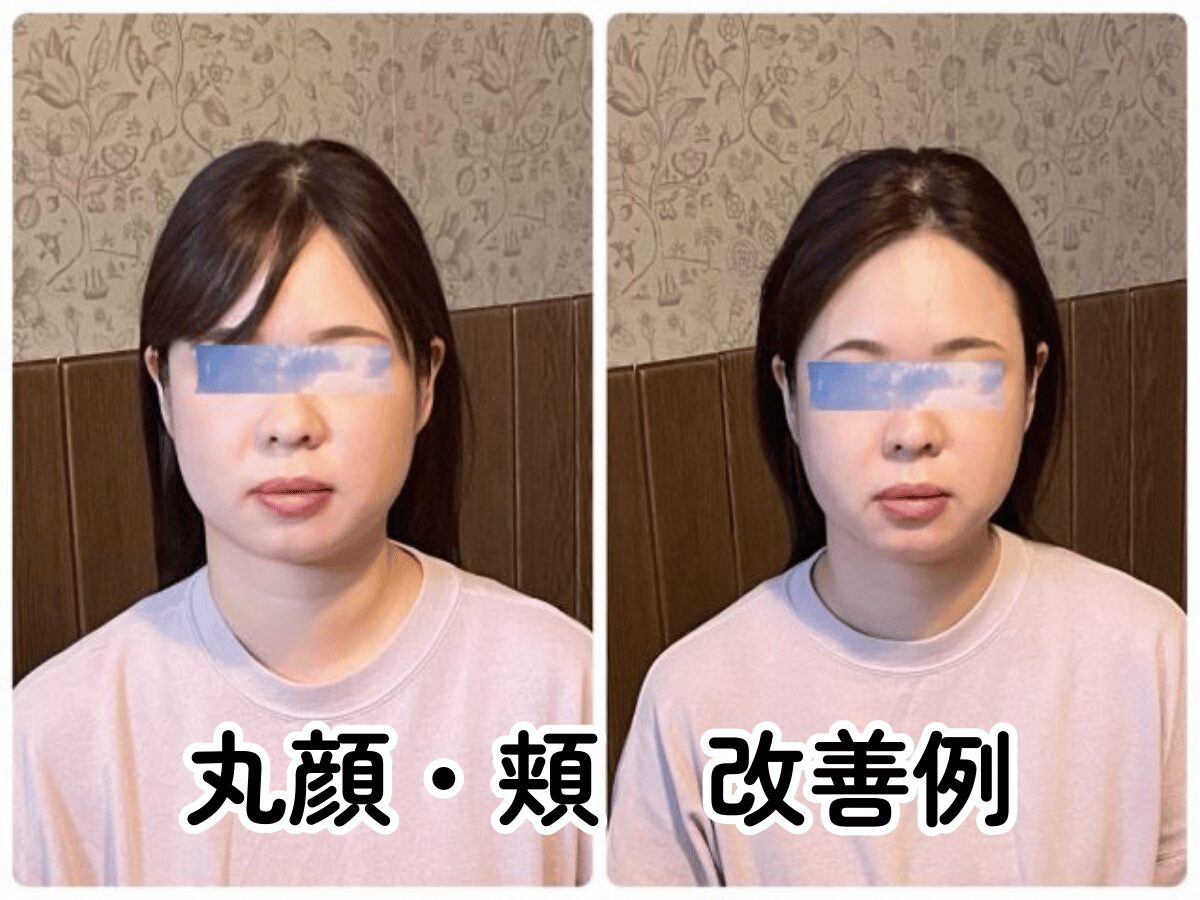 小顔矯正 丸顔 改善 ビフォーアフター 北九州小倉