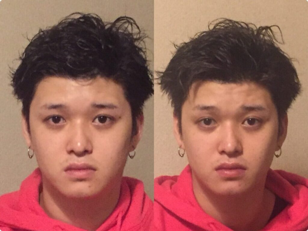 小顔矯正 男性OK ビフォーアフター 北九州小倉