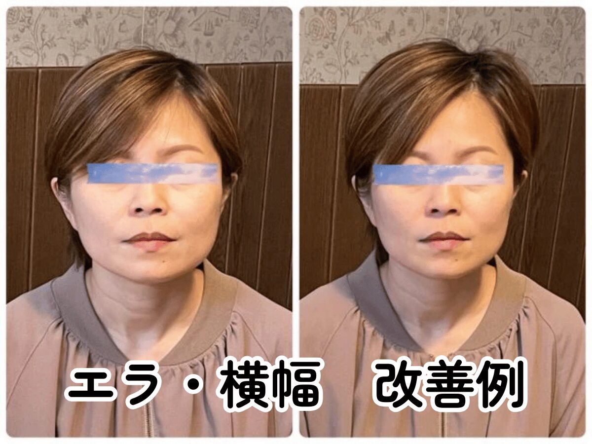 小顔矯正 エラ張り 改善 ビフォーアフター 北九州小倉