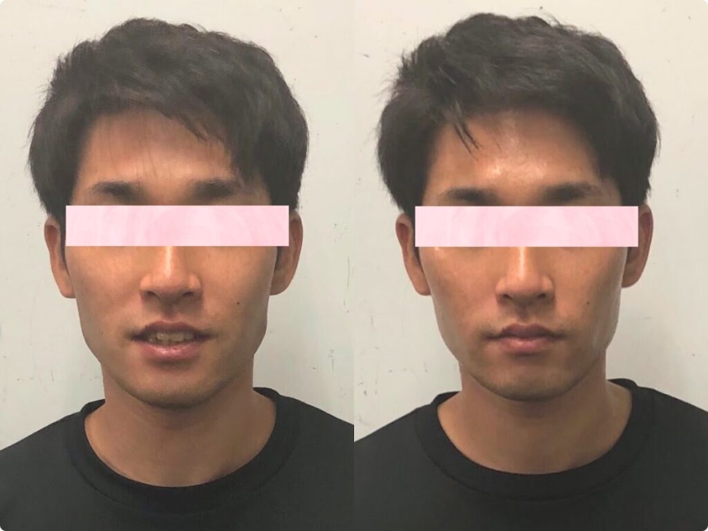 小顔矯正 男性　メンズ ビフォーアフター 北九州小倉