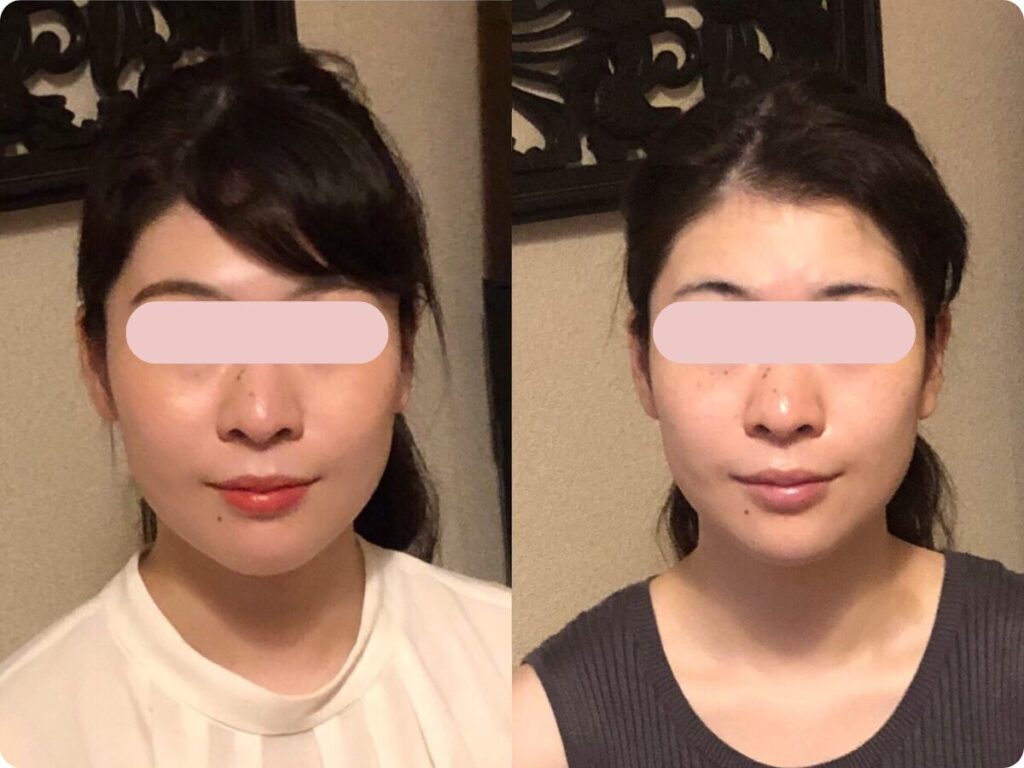 小顔矯正 大切な日のケア ビフォーアフター