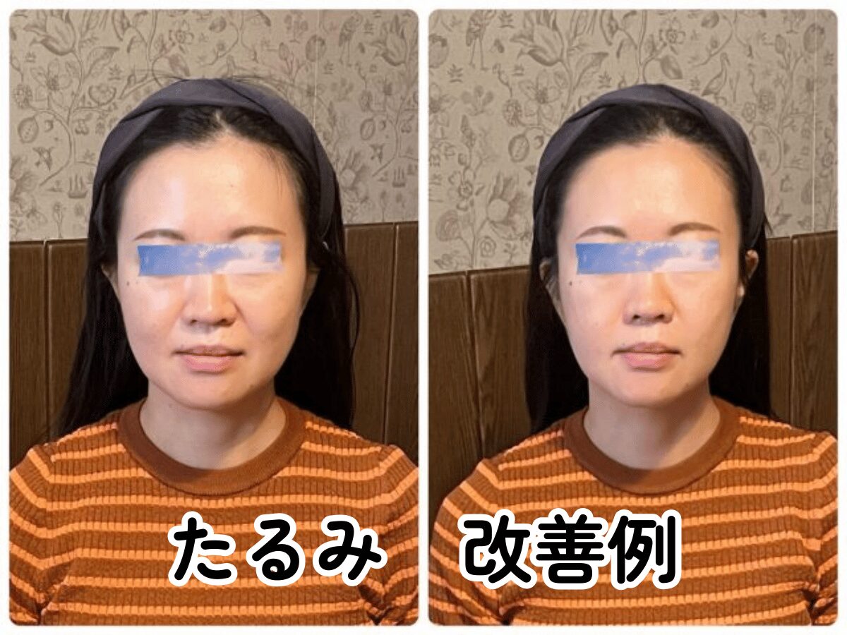 小顔矯正 たるみ 改善 ビフォーアフター 北九州小倉