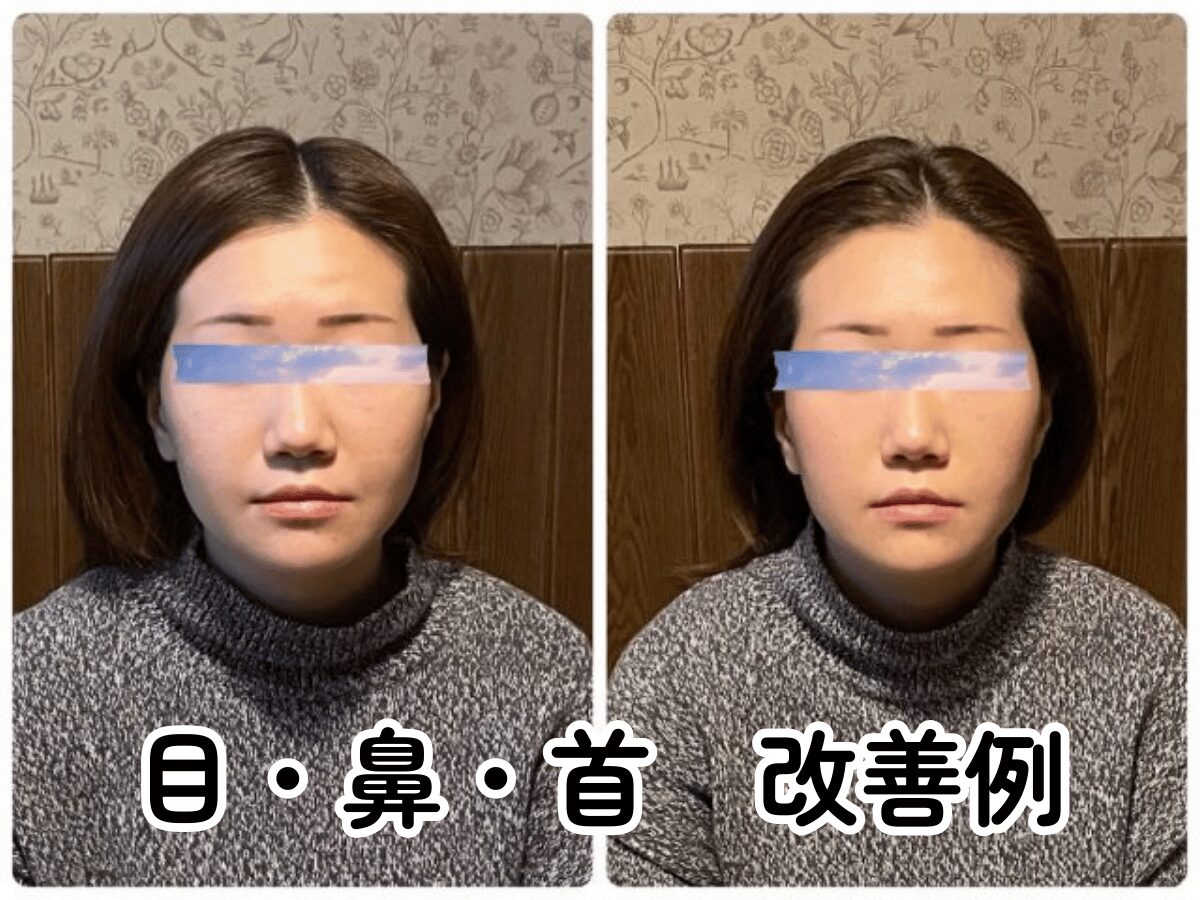 小顔矯正 小鼻　鼻筋 ビフォーアフター 北九州小倉