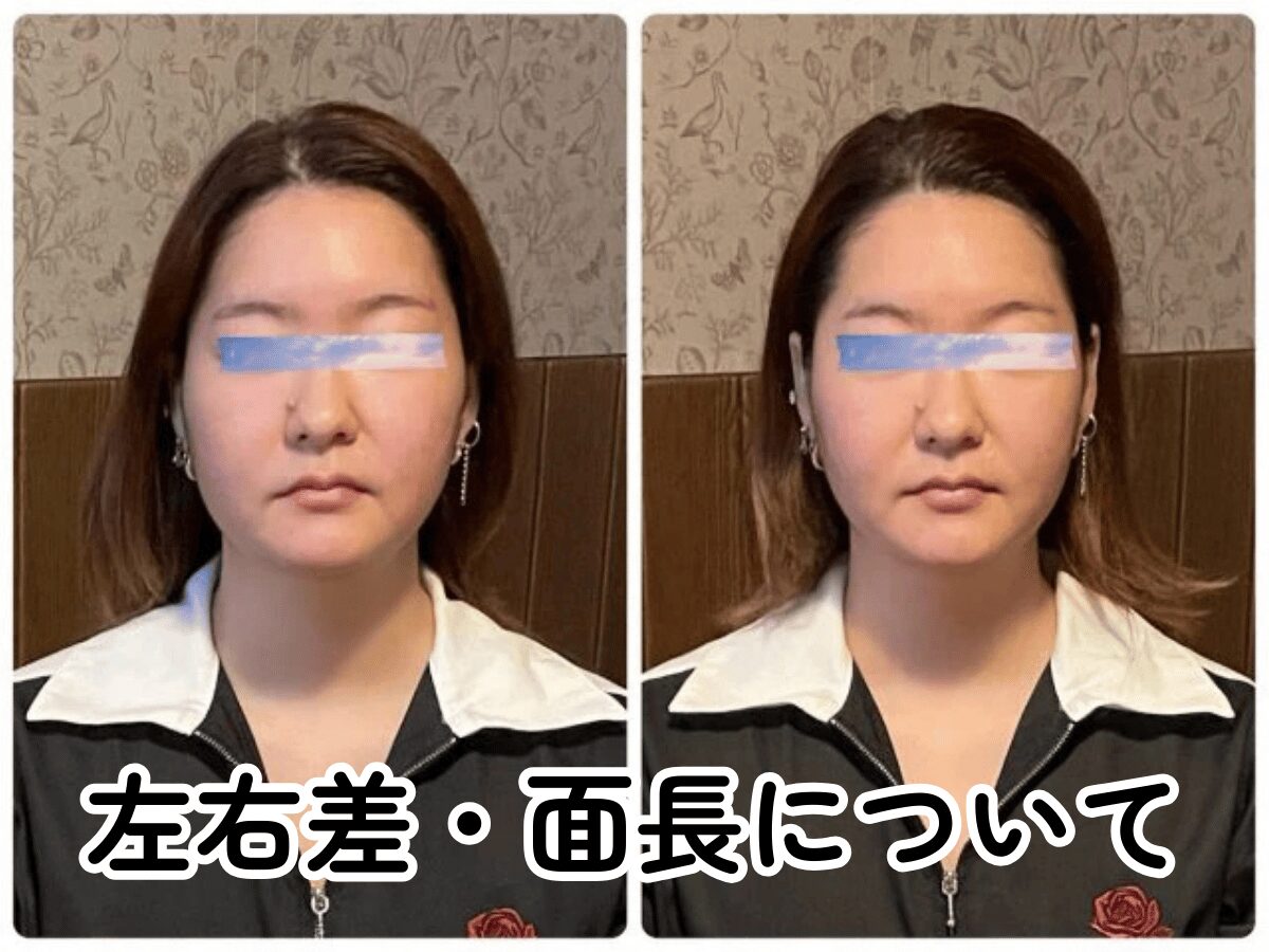 小顔矯正 左右差 ビフォーアフター 北九州小倉