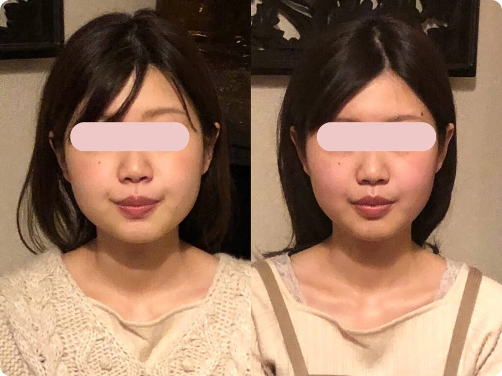小顔矯正 フォトウェディング ビフォーアフター 北九州小倉