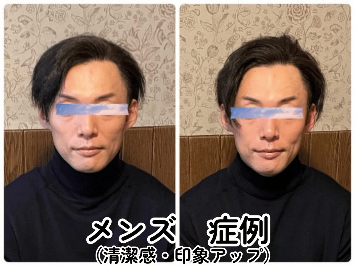 小顔矯正 メンズ　 ビフォーアフター 北九州小倉