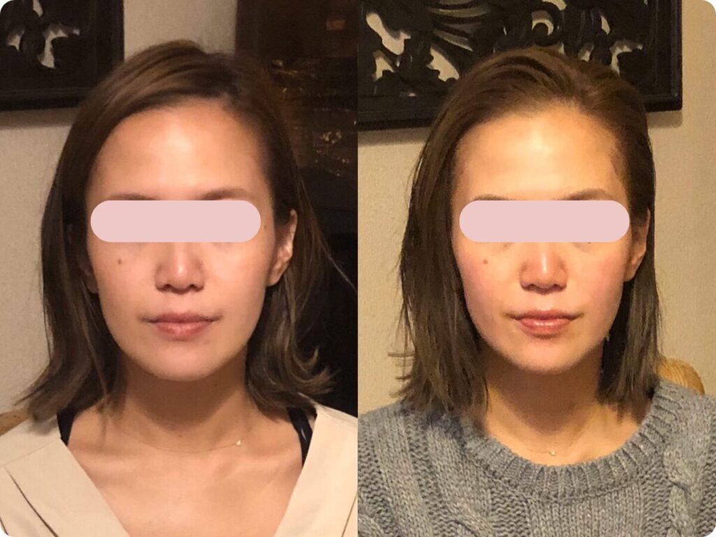 小顔矯正 結婚式 ビフォーアフター 北九州小倉