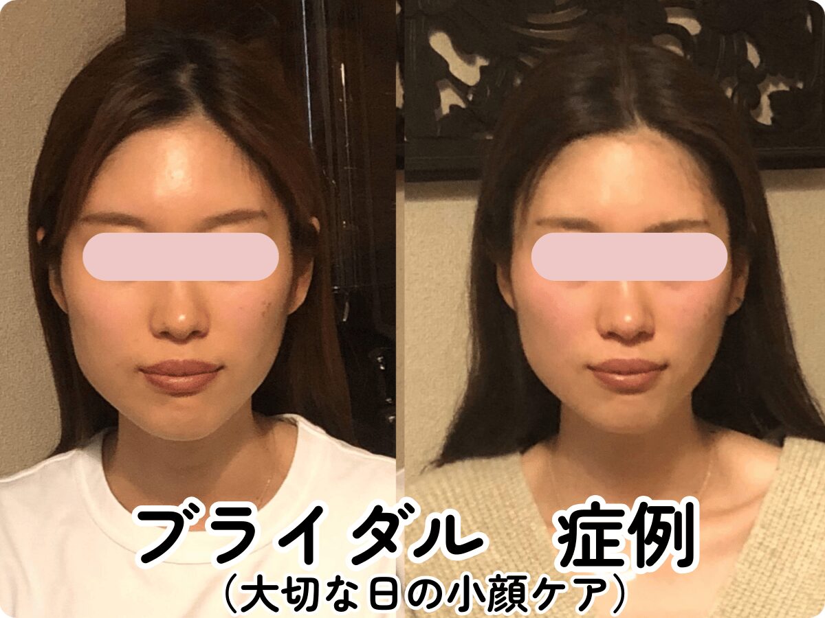 小顔矯正 ブライダル　フォトウェディング ビフォーアフター 北九州小倉